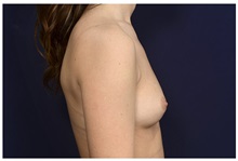 Breast Augmentation Before Photo by Michael Law, MD; Raleigh, NC - Case 32989
