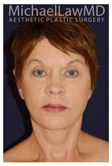 Facelift After Photo by Michael Law, MD; Raleigh, NC - Case 32991
