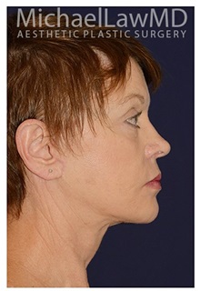 Facelift After Photo by Michael Law, MD; Raleigh, NC - Case 32991
