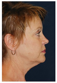 Facelift Before Photo by Michael Law, MD; Raleigh, NC - Case 32991