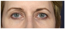 Eyelid Surgery Before Photo by Michael Law, MD; Raleigh, NC - Case 32994