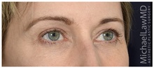 Eyelid Surgery After Photo by Michael Law, MD; Raleigh, NC - Case 32994