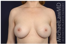 Breast Augmentation After Photo by Michael Law, MD; Raleigh, NC - Case 32995