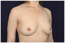 Breast Augmentation Before Photo by Michael Law, MD; Raleigh, NC - Case 32995
