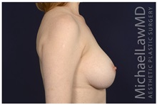 Breast Augmentation After Photo by Michael Law, MD; Raleigh, NC - Case 32995