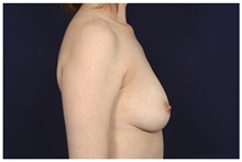 Breast Augmentation Before Photo by Michael Law, MD; Raleigh, NC - Case 32995