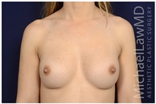 Breast Augmentation After Photo by Michael Law, MD; Raleigh, NC - Case 32996