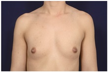 Breast Augmentation Before Photo by Michael Law, MD; Raleigh, NC - Case 32996