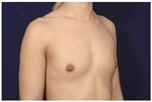 Breast Augmentation Before Photo by Michael Law, MD; Raleigh, NC - Case 32996
