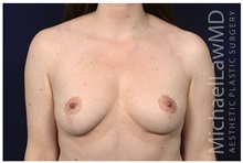 Breast Lift After Photo by Michael Law, MD; Raleigh, NC - Case 32997