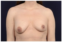 Breast Lift Before Photo by Michael Law, MD; Raleigh, NC - Case 32997