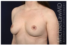 Breast Lift After Photo by Michael Law, MD; Raleigh, NC - Case 32997