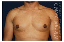 Male Breast Reduction After Photo by Michael Law, MD; Raleigh, NC - Case 32998