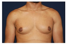 Male Breast Reduction Before Photo by Michael Law, MD; Raleigh, NC - Case 32998