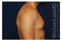 Male Breast Reduction After Photo by Michael Law, MD; Raleigh, NC - Case 32998