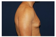 Male Breast Reduction Before Photo by Michael Law, MD; Raleigh, NC - Case 32998