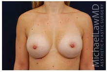 Breast Augmentation After Photo by Michael Law, MD; Raleigh, NC - Case 32999
