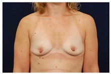 Breast Augmentation Before Photo by Michael Law, MD; Raleigh, NC - Case 32999