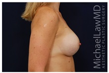 Breast Augmentation After Photo by Michael Law, MD; Raleigh, NC - Case 32999