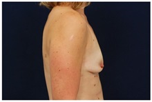 Breast Augmentation Before Photo by Michael Law, MD; Raleigh, NC - Case 32999