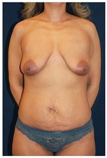 Body Contouring Before Photo by Michael Law, MD; Raleigh, NC - Case 33013