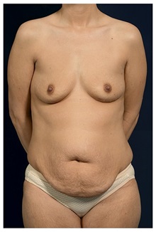 Body Contouring Before Photo by Michael Law, MD; Raleigh, NC - Case 33014