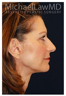 Facelift After Photo by Michael Law, MD; Raleigh, NC - Case 33016