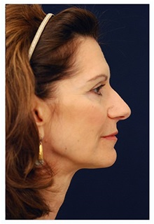 Facelift Before Photo by Michael Law, MD; Raleigh, NC - Case 33016