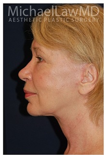 Facelift After Photo by Michael Law, MD; Raleigh, NC - Case 33017