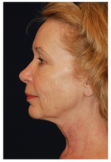 Facelift Before Photo by Michael Law, MD; Raleigh, NC - Case 33017