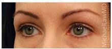 Eyelid Surgery After Photo by Michael Law, MD; Raleigh, NC - Case 33019