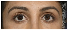 Eyelid Surgery After Photo by Michael Law, MD; Raleigh, NC - Case 33020