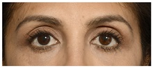Eyelid Surgery Before Photo by Michael Law, MD; Raleigh, NC - Case 33020