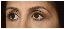 Eyelid Surgery Before Photo by Michael Law, MD; Raleigh, NC - Case 33020