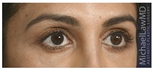 Eyelid Surgery After Photo by Michael Law, MD; Raleigh, NC - Case 33020