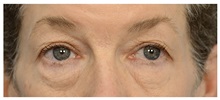 Eyelid Surgery Before Photo by Michael Law, MD; Raleigh, NC - Case 33021