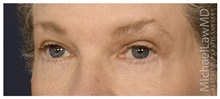 Eyelid Surgery After Photo by Michael Law, MD; Raleigh, NC - Case 33021