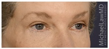 Eyelid Surgery After Photo by Michael Law, MD; Raleigh, NC - Case 33021