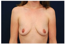 Breast Augmentation Before Photo by Michael Law, MD; Raleigh, NC - Case 33022