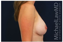 Breast Augmentation After Photo by Michael Law, MD; Raleigh, NC - Case 33022