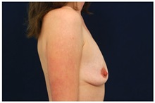 Breast Augmentation Before Photo by Michael Law, MD; Raleigh, NC - Case 33022