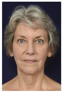 Facelift Before Photo by Michael Law, MD; Raleigh, NC - Case 33023