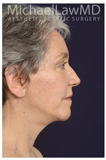 Facelift After Photo by Michael Law, MD; Raleigh, NC - Case 33023