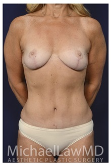Body Contouring After Photo by Michael Law, MD; Raleigh, NC - Case 33024