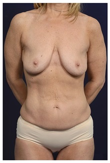 Body Contouring Before Photo by Michael Law, MD; Raleigh, NC - Case 33024