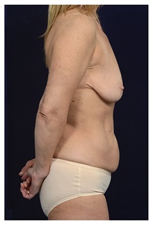 Body Contouring Before Photo by Michael Law, MD; Raleigh, NC - Case 33024