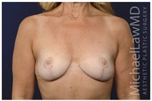 Breast Lift After Photo by Michael Law, MD; Raleigh, NC - Case 33025