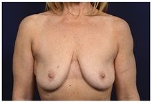 Breast Lift Before Photo by Michael Law, MD; Raleigh, NC - Case 33025