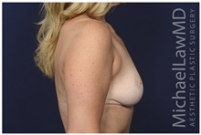 Breast Lift After Photo by Michael Law, MD; Raleigh, NC - Case 33025