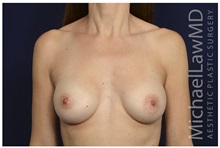Breast Augmentation After Photo by Michael Law, MD; Raleigh, NC - Case 33026